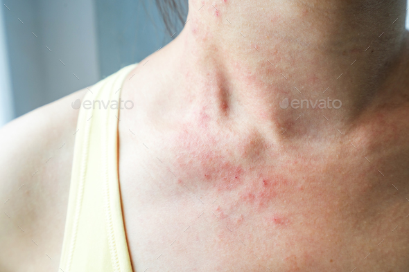 Young woman has skin rash itch on neck Stock Photo by kitzstocker | PhotoDune