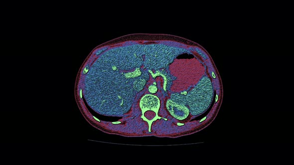 Color Contrast MRI of the Abdominal Cavity, Gastrointestinal Tract, Bladder alt