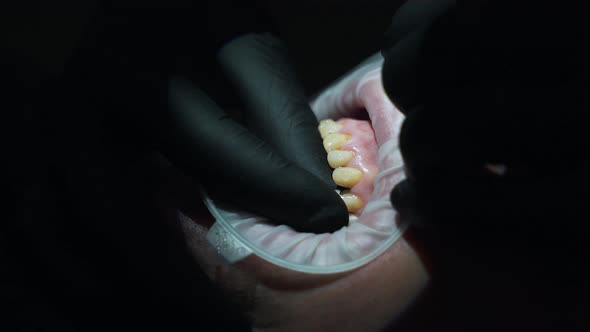Installation of Veneers on the Jaw Closeup