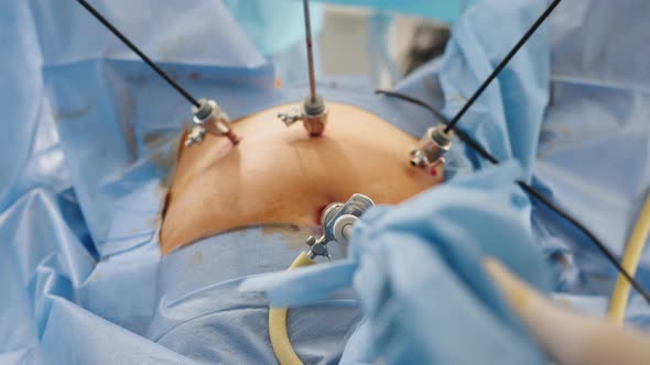 Operation Using Laparoscopic Equipment alt