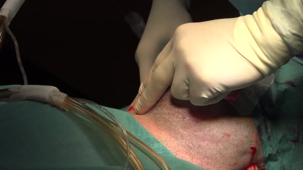 Face and Neck Liposuction for Man 4