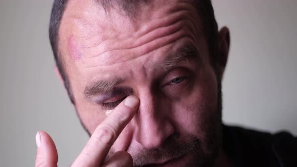 The Man Has a Bruise Under the Eye Smeared with Hematoma Cream on His Face alt