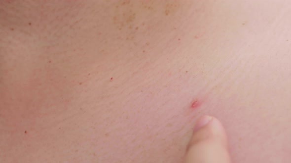 Skin problems acne and big ugly simple close up. Health and skin care concepts. alt