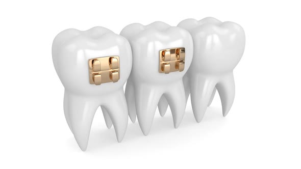 Teeth with  golden orthodontic braces