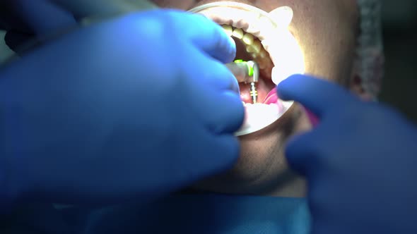Closeup Mouth of Patient in Dental Chair with Doctor Drilling and Assistant Removing Saliva in Slow alt