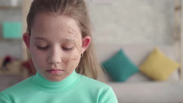 Dramatic Shot Portrait of a Sad Tired Girl with a Defect or a Burned Face alt