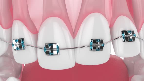 Teeth alignment by orthodontic metal braces isolated over white background