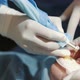 Dentist's Hands Twist the Implant to the Patient - VideoHive Item for Sale