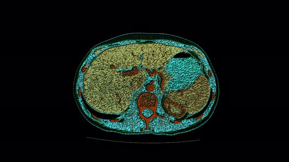 Color Contrast Mri of The Abdominal Cavity, Gastrointestinal Tract ...