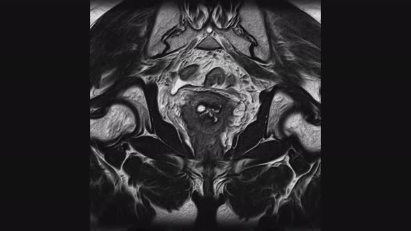 Voluminous MRI of the Female Pelvic Organs, Abdominal Cavity, Gastrointestinal Tract and Bladder alt