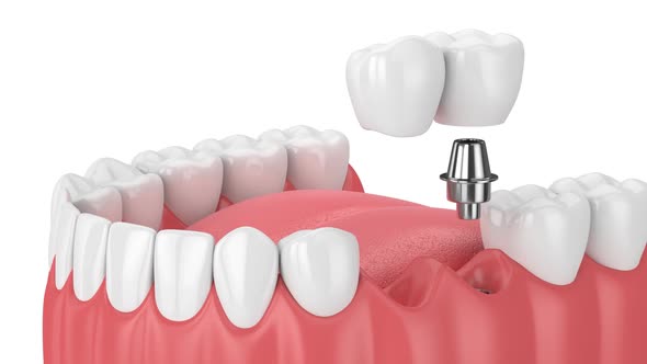 Jaw with implant supported dental cantilever bridge