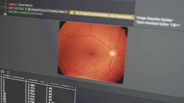 Diabetic and Hypertensive retinopathy Glaucoma Detection with Neural Network ML alt