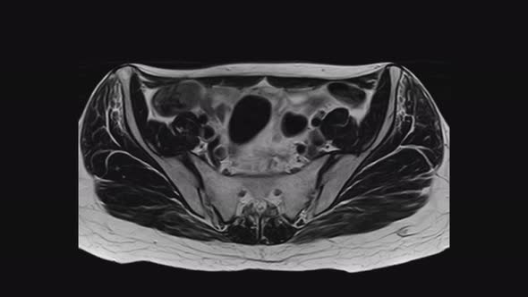 MRI of the Female Pelvic Organs, Abdominal Cavity, Gastrointestinal Tract and Bladder alt