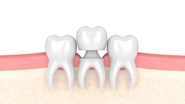 Gums with dental composite crown filling