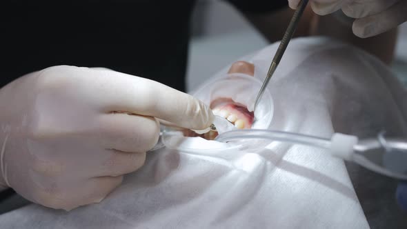 Preparation for the Process of Dental Implantation in a Dental Clinic