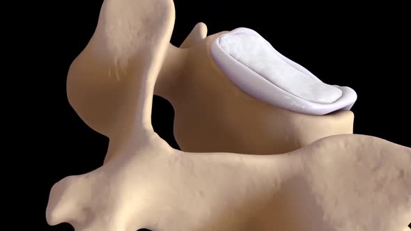 Two pieces of vertebrae in the nerve roots at the back of the spine are called lamina. alt