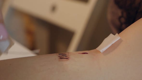 Women's Hands Remove the Catheter From the Vein After the Injection Blood Flows From the Vein and a alt