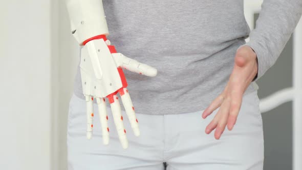 Patient Is Testing His New Robotic Prosthetic Hand on the First Time alt