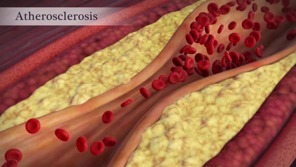 Clogged Artery with platelets and cholesterol plaque, concept for health risk for obesity alt