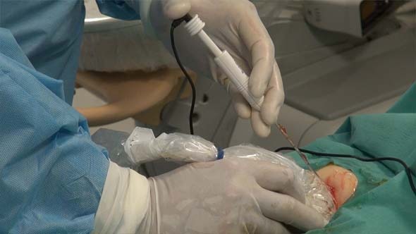 Doctor's Hands And Radiofrequency Ablation alt