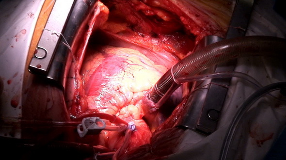 Beating Heart