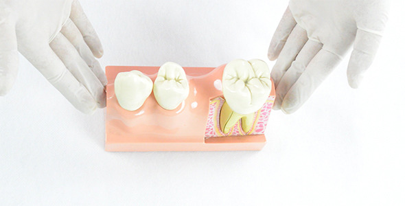 Hands Showing Patient Education Dental Model alt