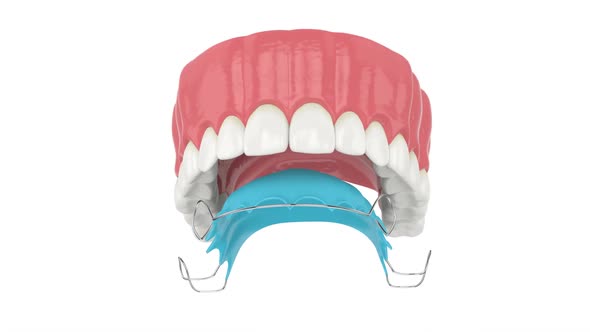 Upper jaw with orthodontic removable retainer