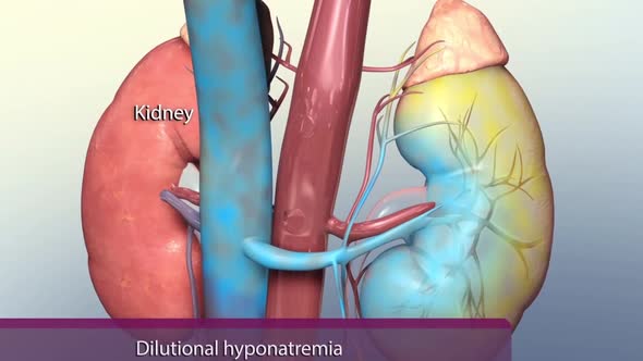 Hyponatremia is caused by below normal blood sodium concentration in the kidney. alt