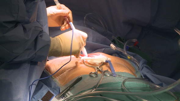 Surgeon Uses Electrocauterization To Stop Bleeding (5 Of 10)