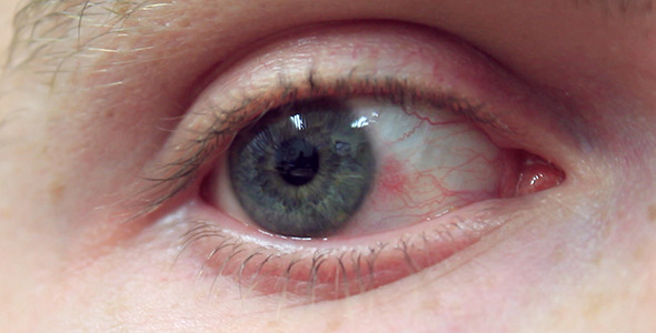 Blue Eye with Mild Nodular Episcleritis