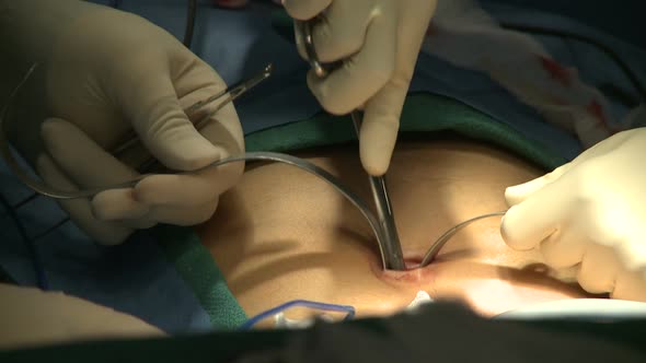 Surgeon Makes Incisions For Laparoscopic Surgery (3 Of 4)