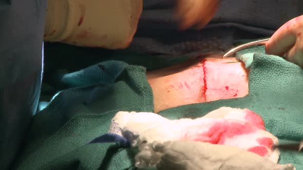 Surgeon Stitching Up Abdomen (1 Of 14)