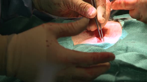 Surgeon Stitching Up Abdomen (6 Of 14)