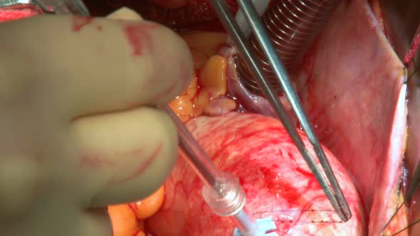 Heart Beating During Aneurysm Surgery (2 Of 2)