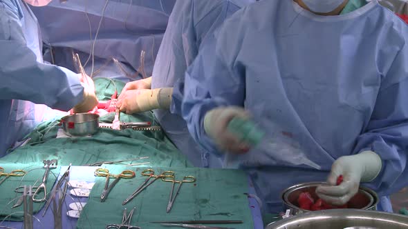 Instrument Table During Surgery (1 Of 2)