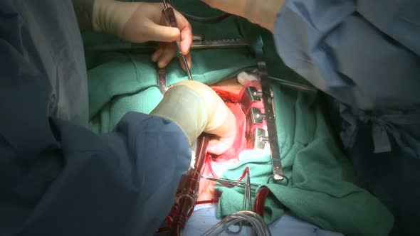 Doctor's Hands Perform Open Heart Surgery