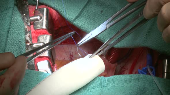Close-Up Of Surgeon's Hands During Operation (12 Of 12)