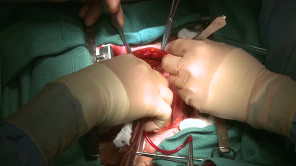 Close-Up Of Surgeon's Hands During Operation (6 Of 12)