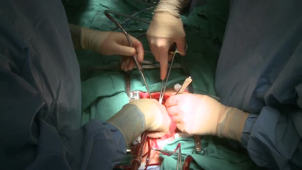 Surgeon Uses Rib Retractor And Cautery During Surgery
