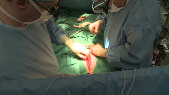Surgeons Stitching Chest Operation