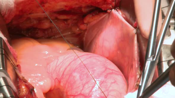 Heart Beats Through Open Chest During Surgery (9 Of 9)