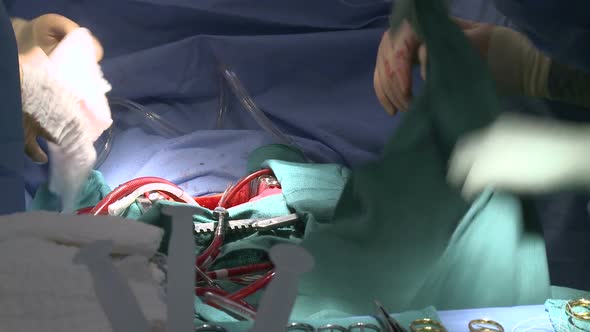 Surgeon Wipes Off Gloves During Surgery