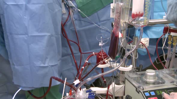 Surgery In Progress Using Heart Lung Bypass Machine