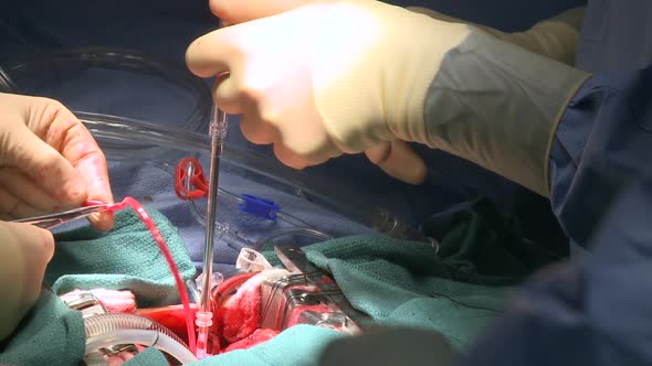 Doctors Perform Heart Surgery