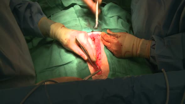 Zoom Out Of Surgeons Suturing Chest Incision