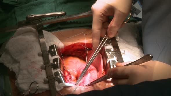 Heart Beats Through Open Chest During Surgery 4 Of 9 By
