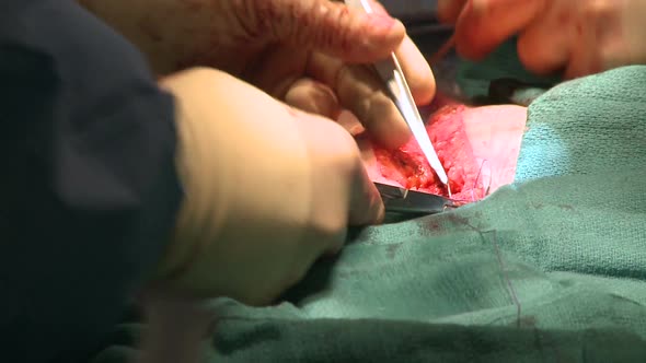 Surgeon Stitching Up Abdomen (13 Of 14)