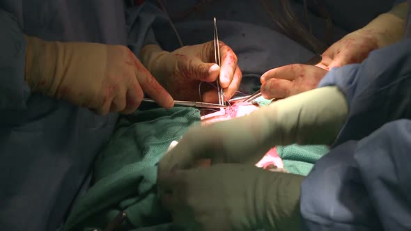 Surgeon Stitching Up Abdomen (2 Of 14)