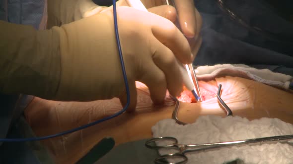 Surgeon Uses Electrocautery During Surgery