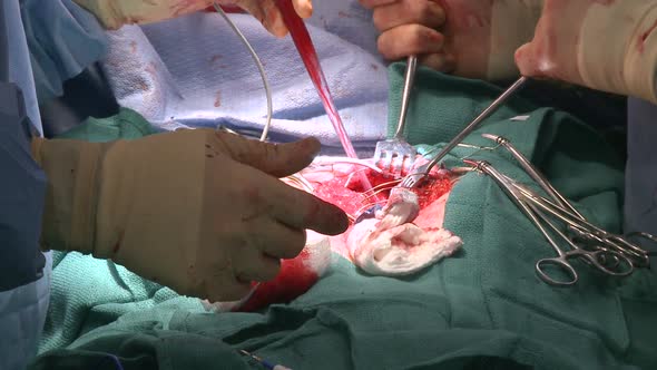 Surgeon Using Cell-Salvage And Electrocautery During Surgery (4 Of 4)